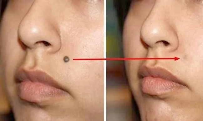 Menghilangkan Tahi Lalat Tanpa Operasi, Disebut Bisa Memakai Kulit Pisang