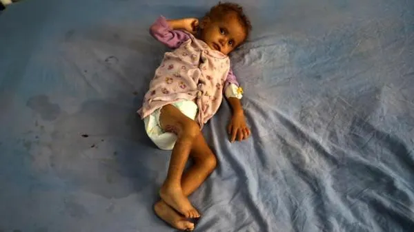 FAO: Lebih dari 52 Juta Orang di Timur Tengah dan Afrika Utara Alami Kekurangan Gizi, Banyak di Zona Konflik