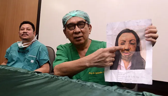 Siti Nurjazilah Jalani Operasi Wajah ke-17 di RSU dr Sutomo Surabaya