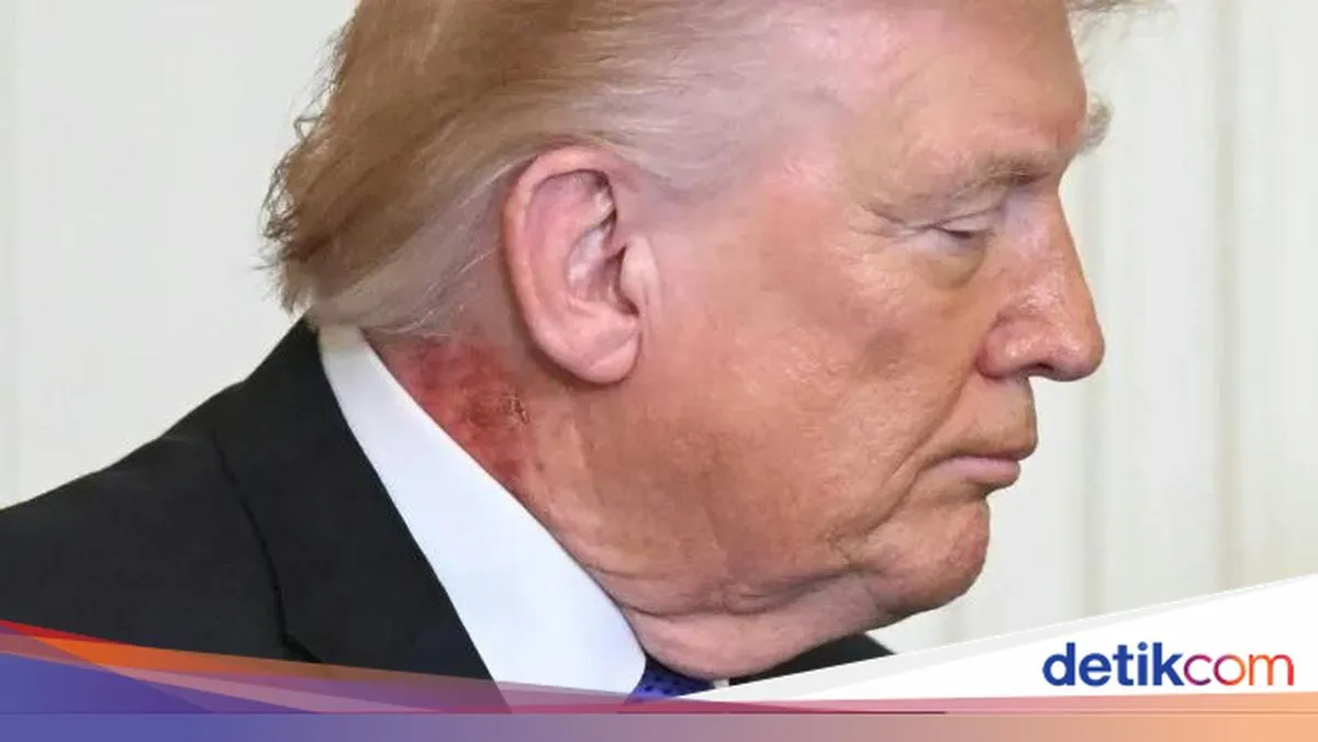 Ruam Merah di Leher Trump dan Cara Publik Membaca Kesehatan Pemimpin