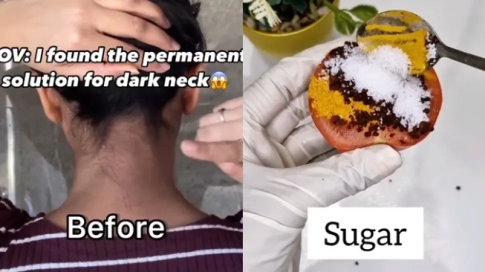 Cara Mencerahkan Tengkuk Gelap dengan Empat Bahan Dapur, Ini Penjelasannya