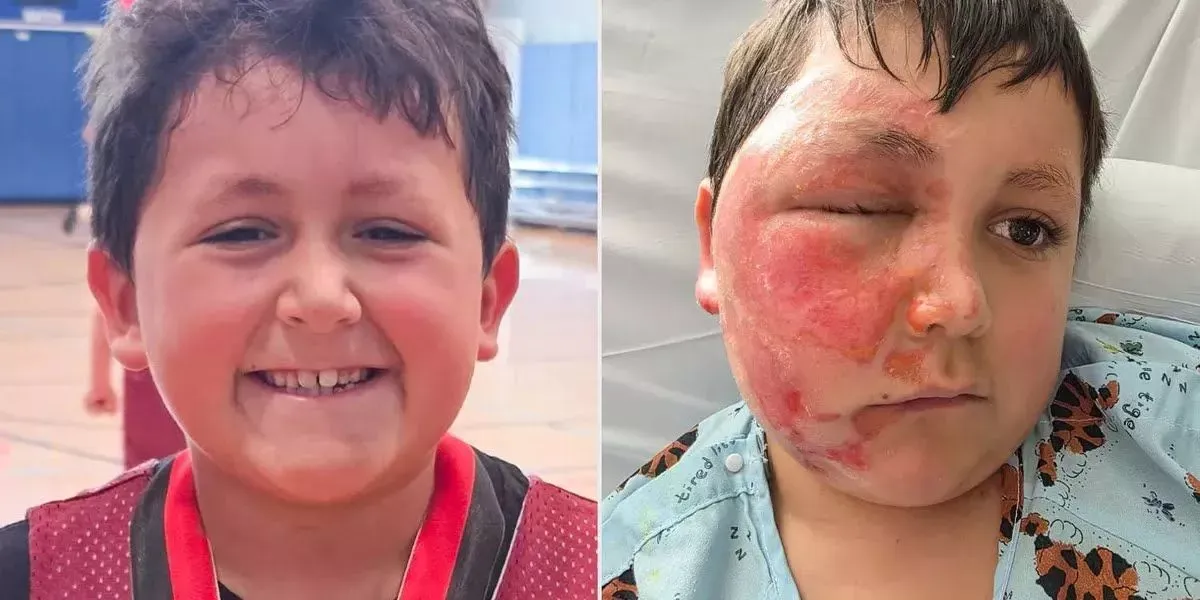 Anak 9 Tahun Alami Luka Bakar Usai Ikuti Tren Viral, Pengawasan Bermedia Sosial Kembali Disorot