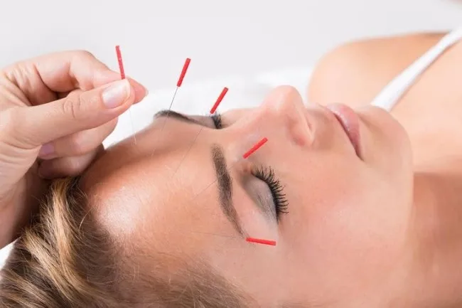 Tren Akupuntur Wajah Menguat pada 2026, Disebut Jadi Alternatif Botox dengan Hasil Lebih Natural