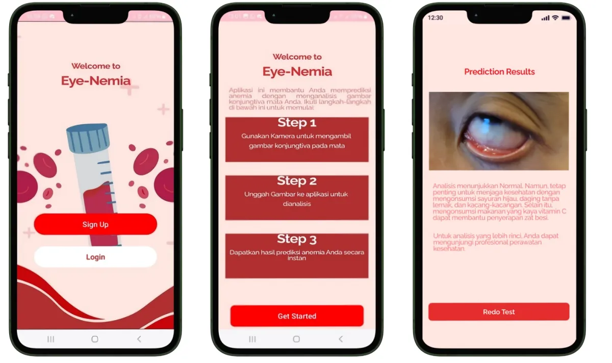 Dosen UMM Kembangkan Aplikasi Berbasis AI untuk Deteksi Anemia Lewat Kamera Ponsel