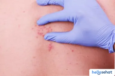Pilihan Pengobatan Cacar Api: Antivirus, Pereda Nyeri, hingga Perawatan Rumahan