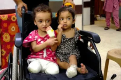 Anak-anak Palestina korban serangan Israel di Gaza yang menjalani amputasi.